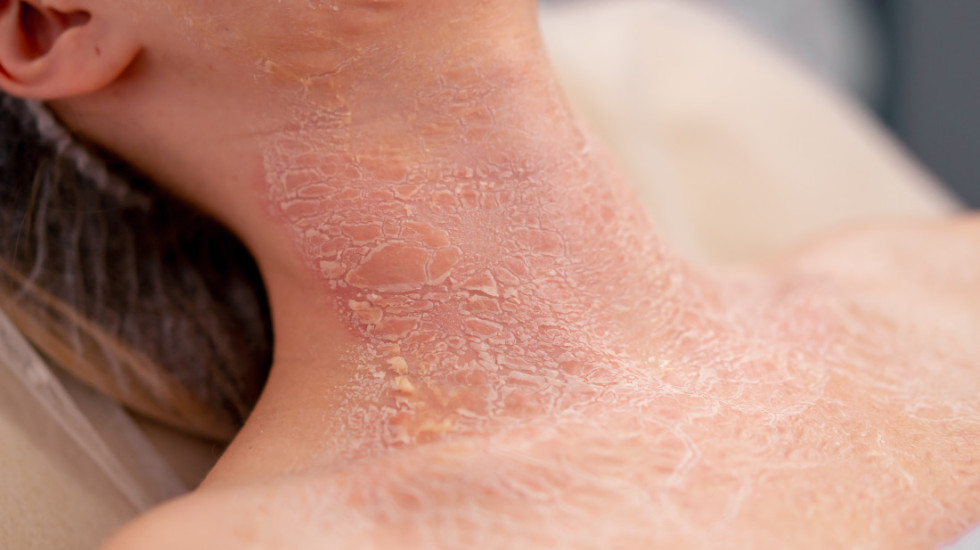 Psorijazu u Srbiji ima 140.000 ljudi: "Nije zarazna bolest, ne raditi ništa na svoju ruku kad se pojave simptomi"