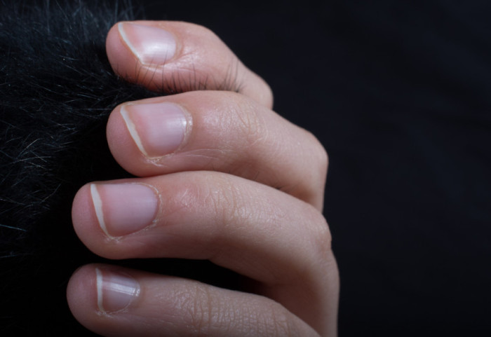 Promene na noktima mogu ukazivati na ozbiljne zdravstvene probleme: Reagujte na vreme