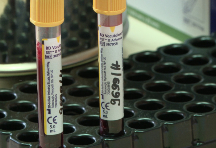 Deca obolela od talasemije se posle transfuzije krvi zarazila virusom HIV u Indiji