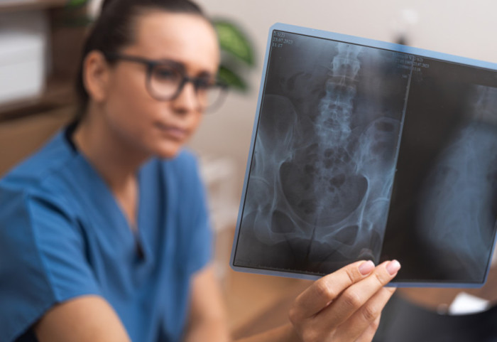 Mikroplastika detektovana i u ljudskim kostima: Da li je ovo skriveni faktor koji slabi naš skelet