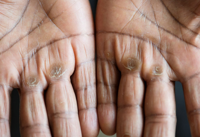 Potvrđeni slučajevi gube u Hrvatskoj i Rumuniji: Dijagnoza postavljena Nepalcu i Azijatkinji