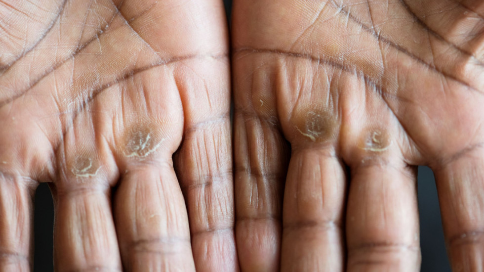 Potvrđeni slučajevi gube u Hrvatskoj i Rumuniji: Dijagnoza postavljena Nepalcu i Azijatkinji