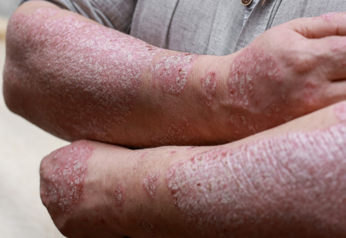 Batut: Lepra se godišnje registruje kod oko 200.000 ljudi globalno, period inkubacije može da traje i deceniju