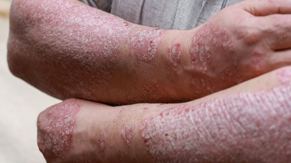 Batut: Lepra se godišnje registruje kod oko 200.000 ljudi globalno, period inkubacije može da traje i deceniju