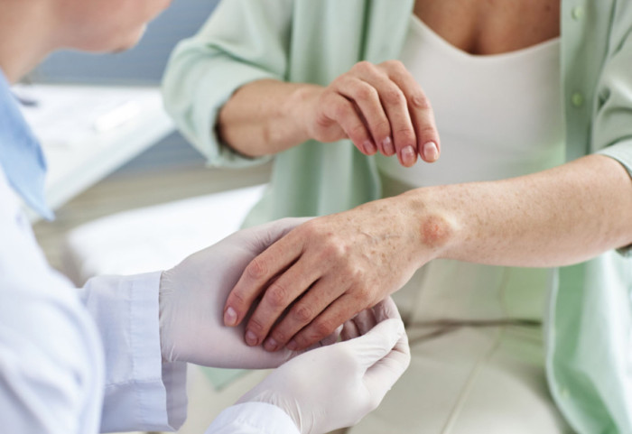 Kako prepoznati gubu: "Počinje s promenama na koži, oštećuje nerve, prenosi se kapljičnim putem"