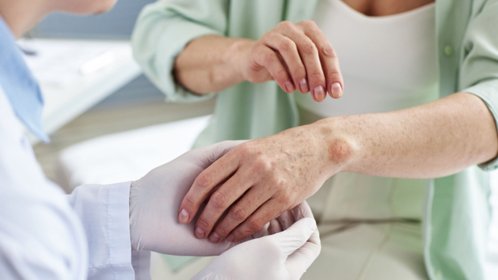 Kako prepoznati gubu: "Počinje s promenama na koži, oštećuje nerve, prenosi se kapljičnim putem"