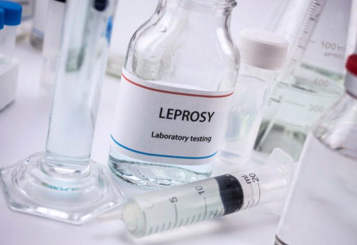 Epidemiolog Radovanović o riziku od izbijanja lepre u Srbiji: Bezbedni smo, guba pripada prošlosti što se nas tiče