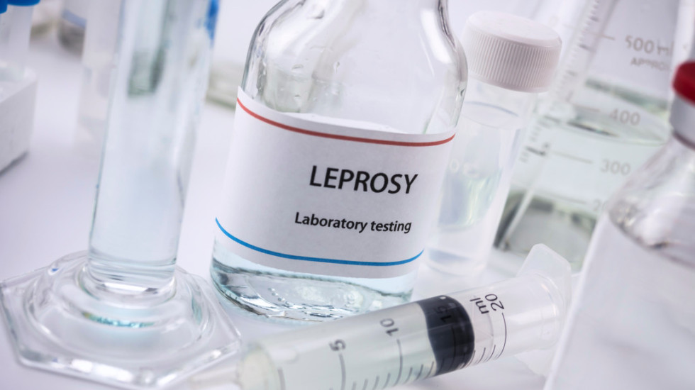 Epidemiolog Radovanović o riziku od izbijanja lepre u Srbiji: Bezbedni smo, guba pripada prošlosti što se nas tiče