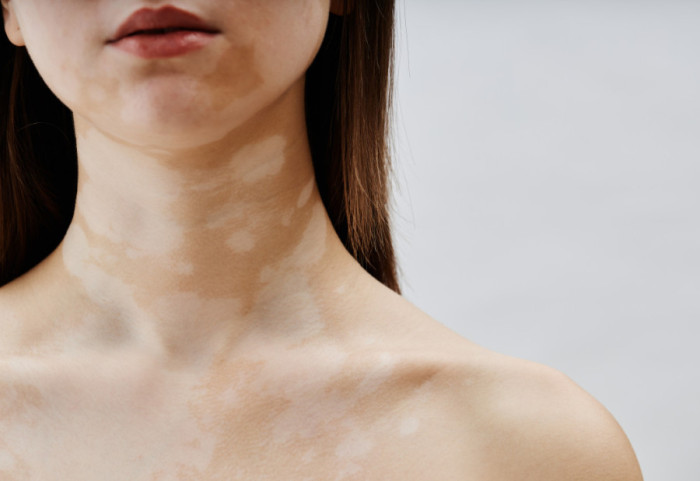 Život sa vitiligom: Autoimuna bolest koja otvara brojna medicinska i društvena pitanja