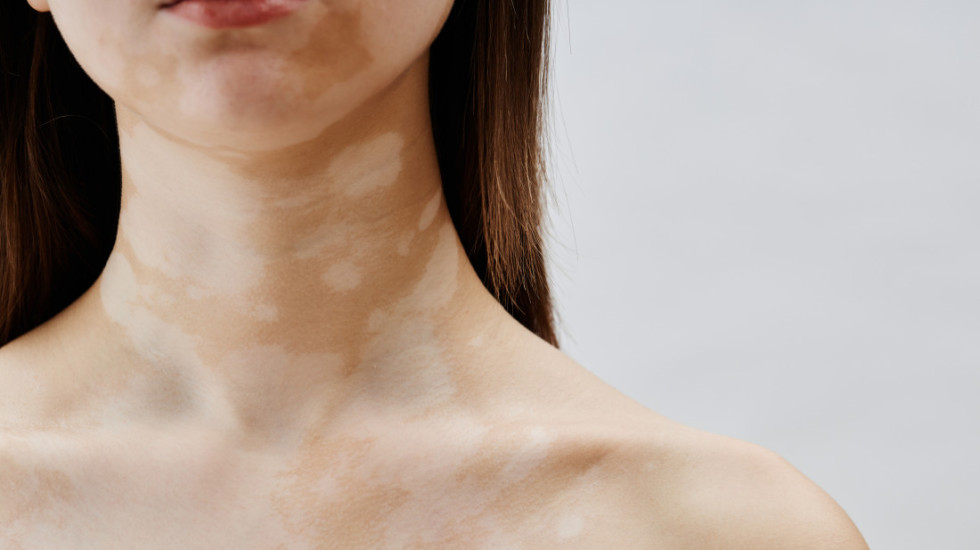 Život sa vitiligom: Autoimuna bolest koja otvara brojna medicinska i društvena pitanja