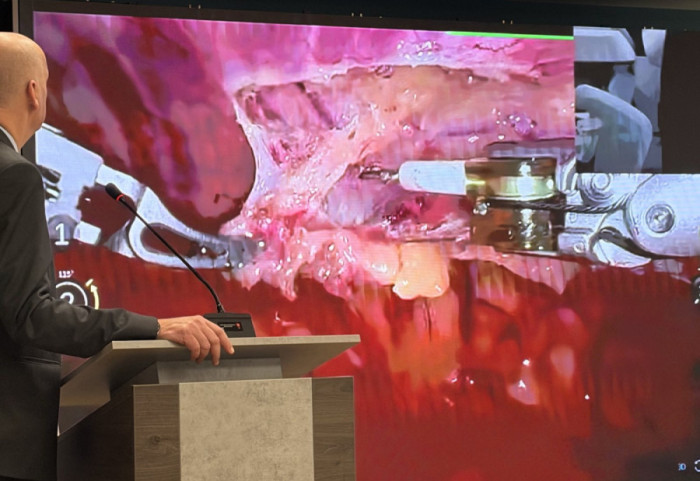 Na Institutu Dedinje izvedena prva robotski asistirana operacija na srcu