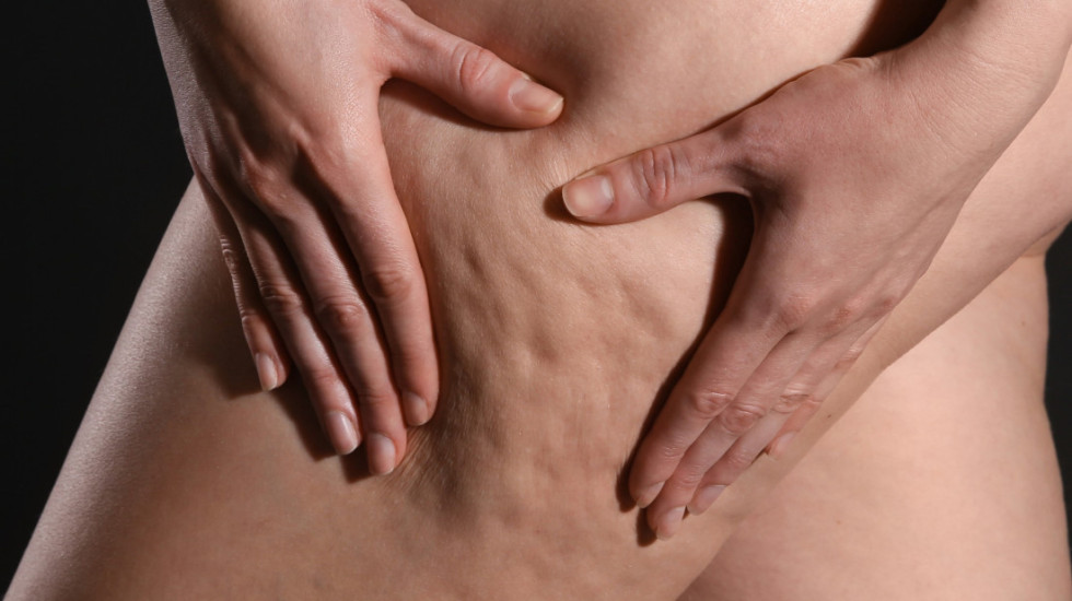 Namirnice koje mogu da pomognu u smanjenju celulita